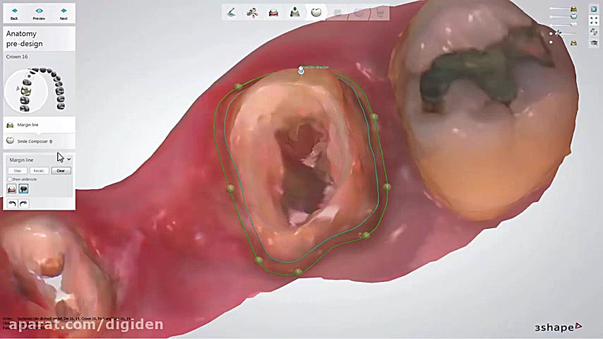 پست و کور با دنتال سیستم 3shap...