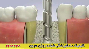ایمپلنت دندان Dental implant