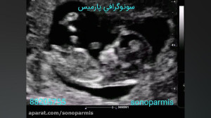 سونوگرافی غربالگری سه ماهه دوم...