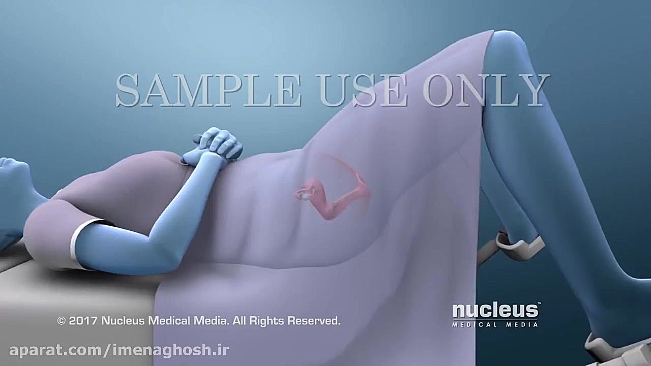 آزمایش پاپ اسمیر و زگیل تناسلی