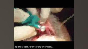 جراحی ایمپلنت چائروم fresh soc...