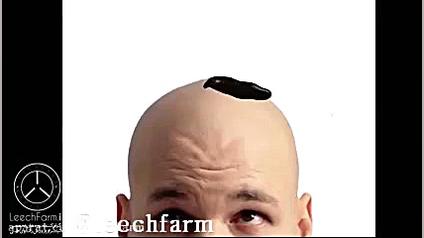 زالو درمانی جهت کمک به رویش مج...