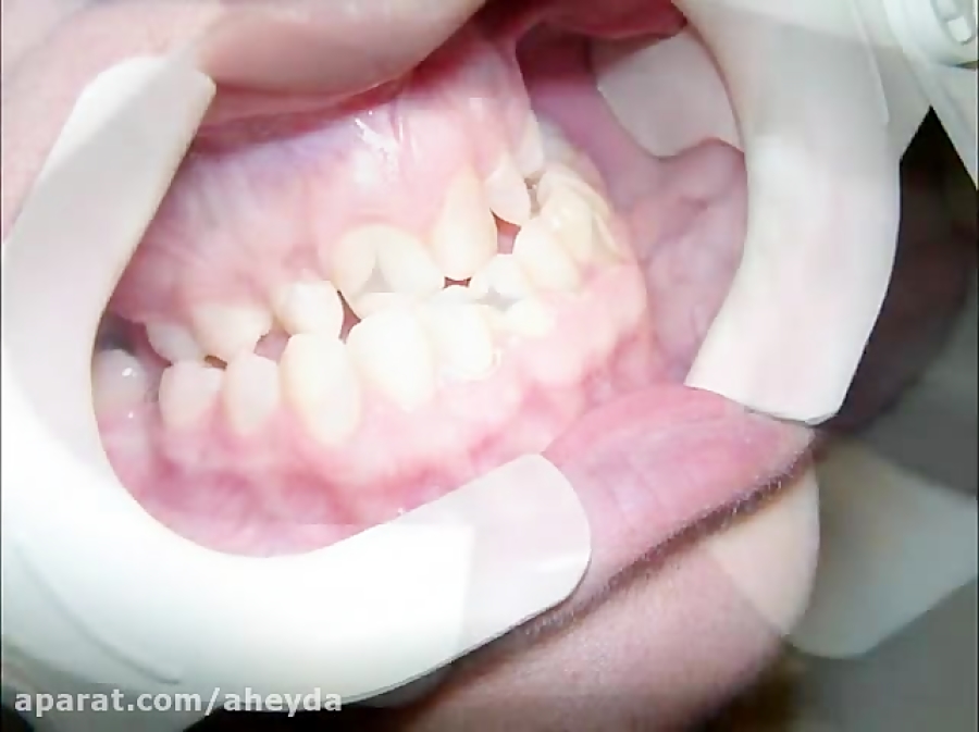 prognathic lower jaw treatment,case of the month