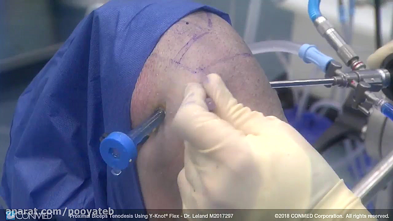 Dr. Martin Leland  Biceps Teno...