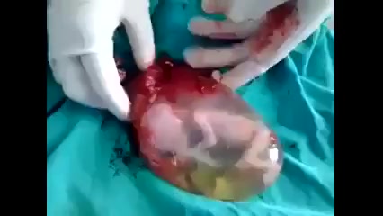 جنین در کیسه آب