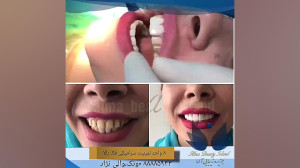 لمینیت سرامیکی دندانپزشک دکتر...