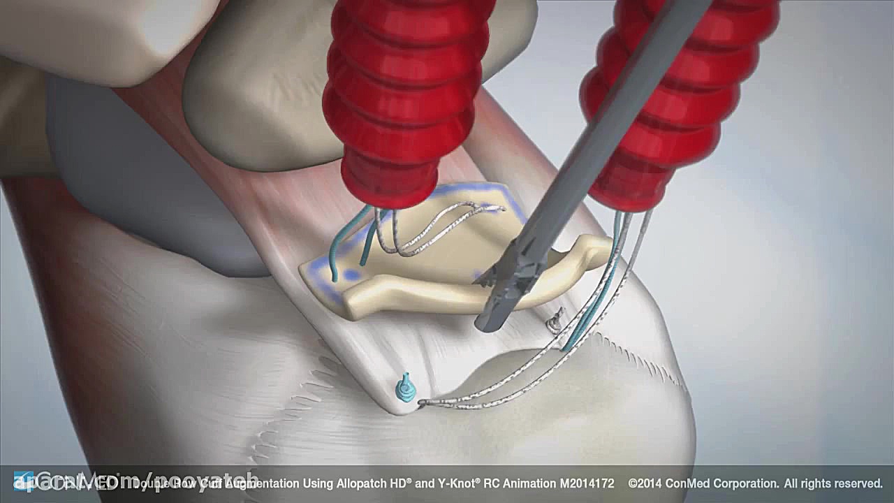 Double Row Rotator Cuff Augmen...