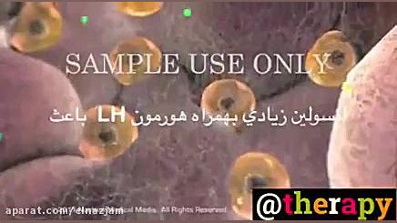 تخمدان پلی کیستیک (تنبلی تخمدا...