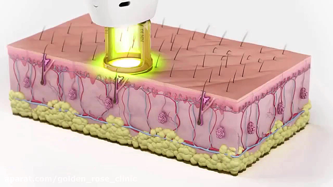 لیزر موهای زائد توسط لیزر الکس...