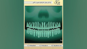 مراحل رویش دندان های شیری و دا...