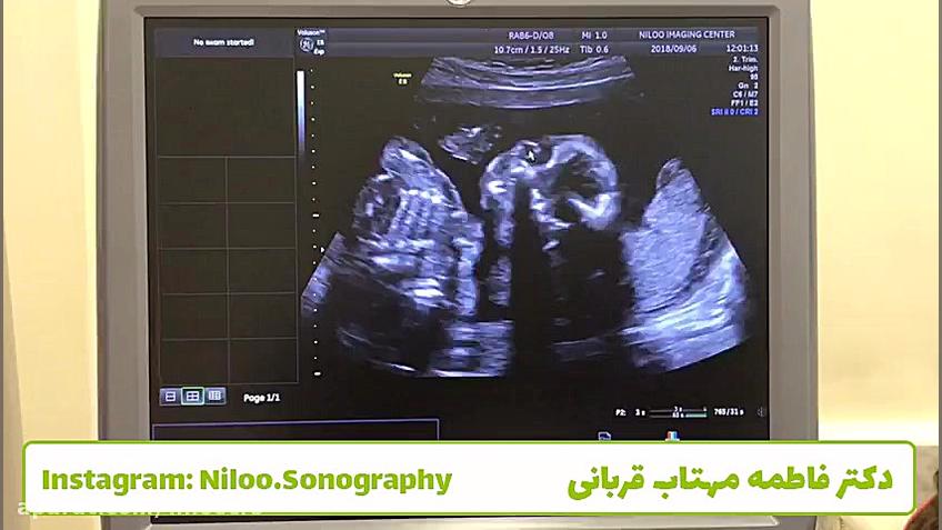 سونوگرافی جنین  آب مروارید ماد...
