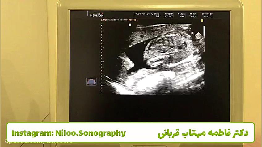 سونوگرافی جنین  قیفی شدن کیسه...