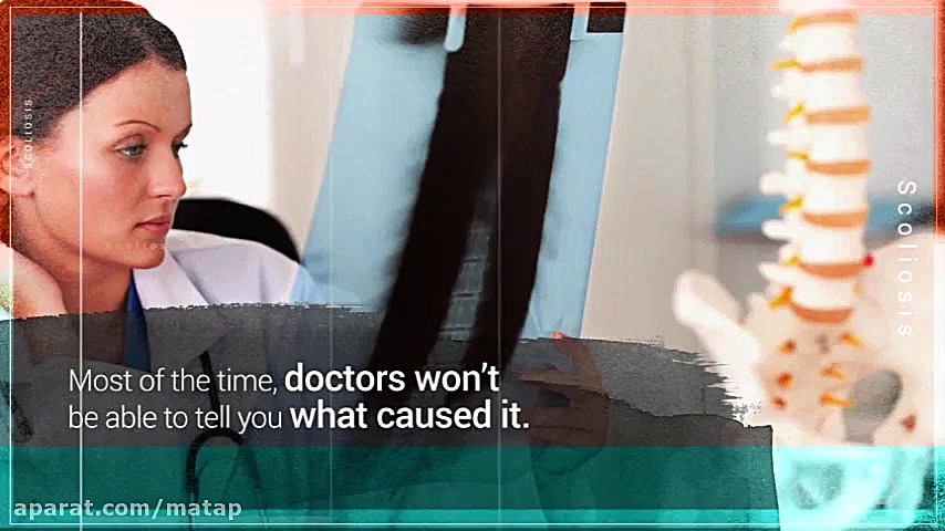 اسکولیوز(انحراف ستون فقرات) چی...