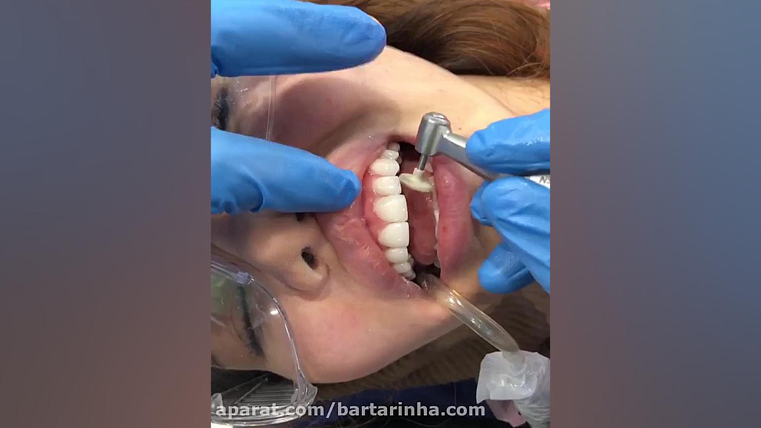 دنتال زعفرانیه لمینت یا کامپوز...