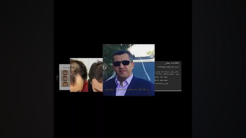 جدید ترین روش کاشت مو چیست؟