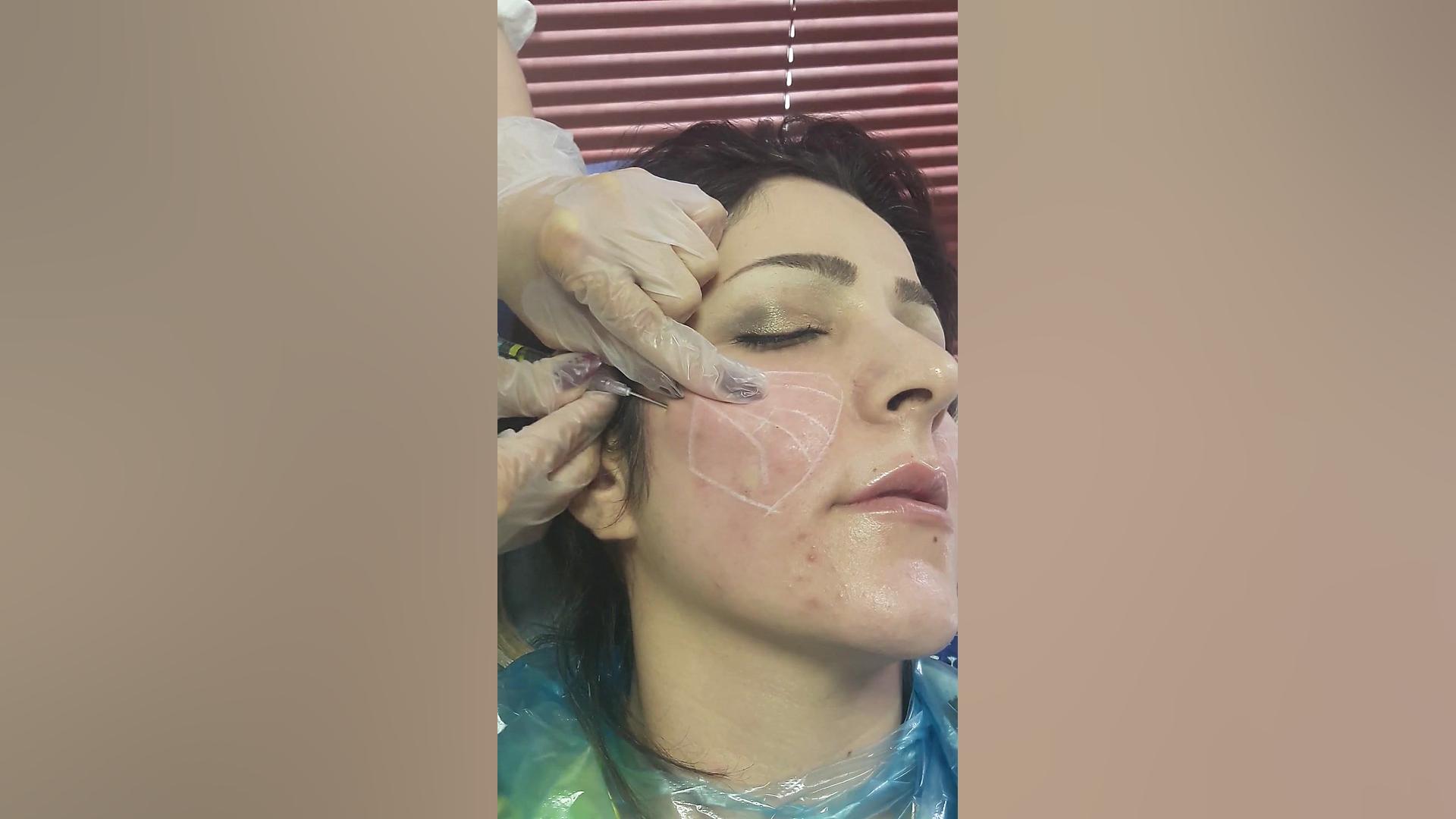 درمان جای جوش با سابسیژن موگه...