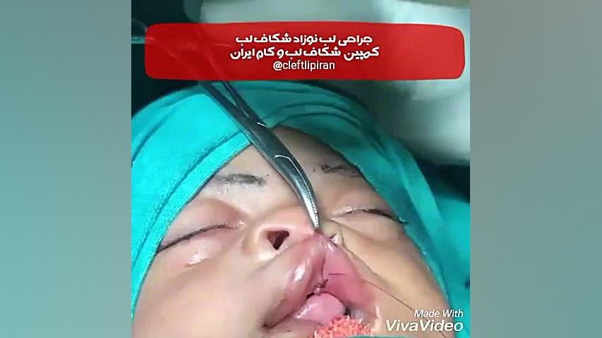 جراحی لب نوزاد شکاف لب