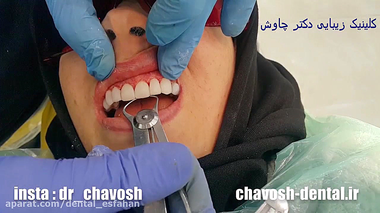 پالیش اولیه کامپوزیت ونیر دندا...