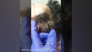 رفع کم پشتی موی سر
