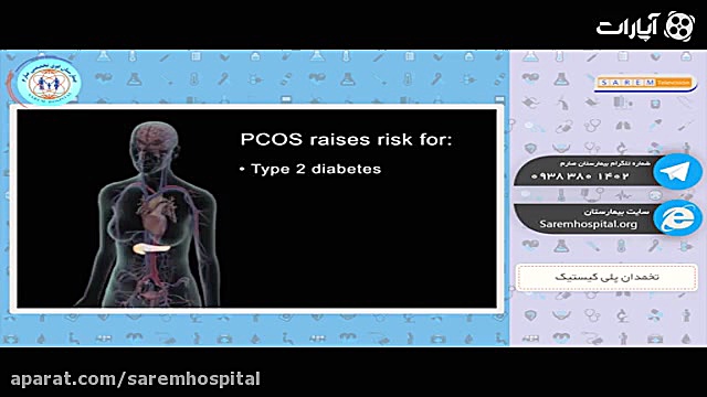تخمدان پلی کیستیک در کمین همه...