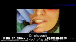 کاشت و چسباندن روکش 5 واحد ایم...