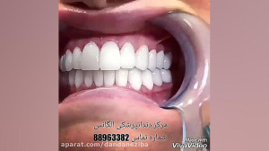ونیر کامپوزیت | پرسلن کامپوزیت...