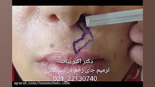 اسکار ترمیم زخم صورت