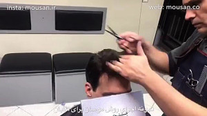 پروتز مو آقایان کلینیک موسان