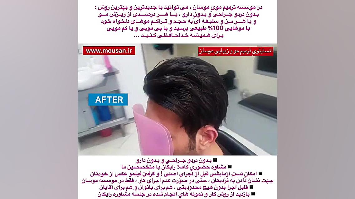 پروتز مو آقایان