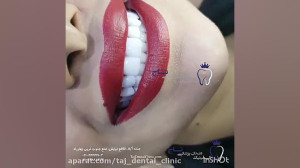 اصلاح طرح لبخند انجام شده به ر...