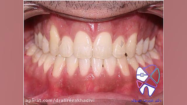 اصلاح بیرون زدی فک پایین