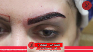کاشت ابرو | فیلم کاشت ابرو | ک...