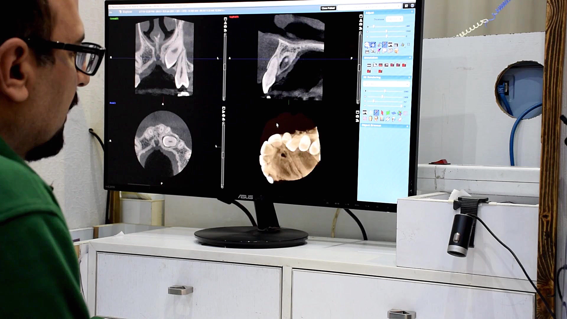 بررسی کانین نهفته با CBCT