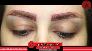 کاشت ابرو | فیلم کاشت ابرو | ک...