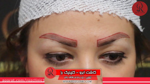کاشت ابرو | فیلم کاشت ابرو | ک...