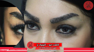 کاشت ابرو | فیلم کاشت ابرو | ک...