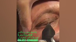 بلفاروپلاستی با دستگاههای پیشر...