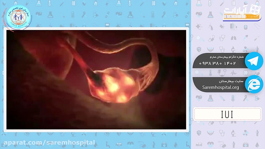 IUI چگونه به زوج های نازا برای...