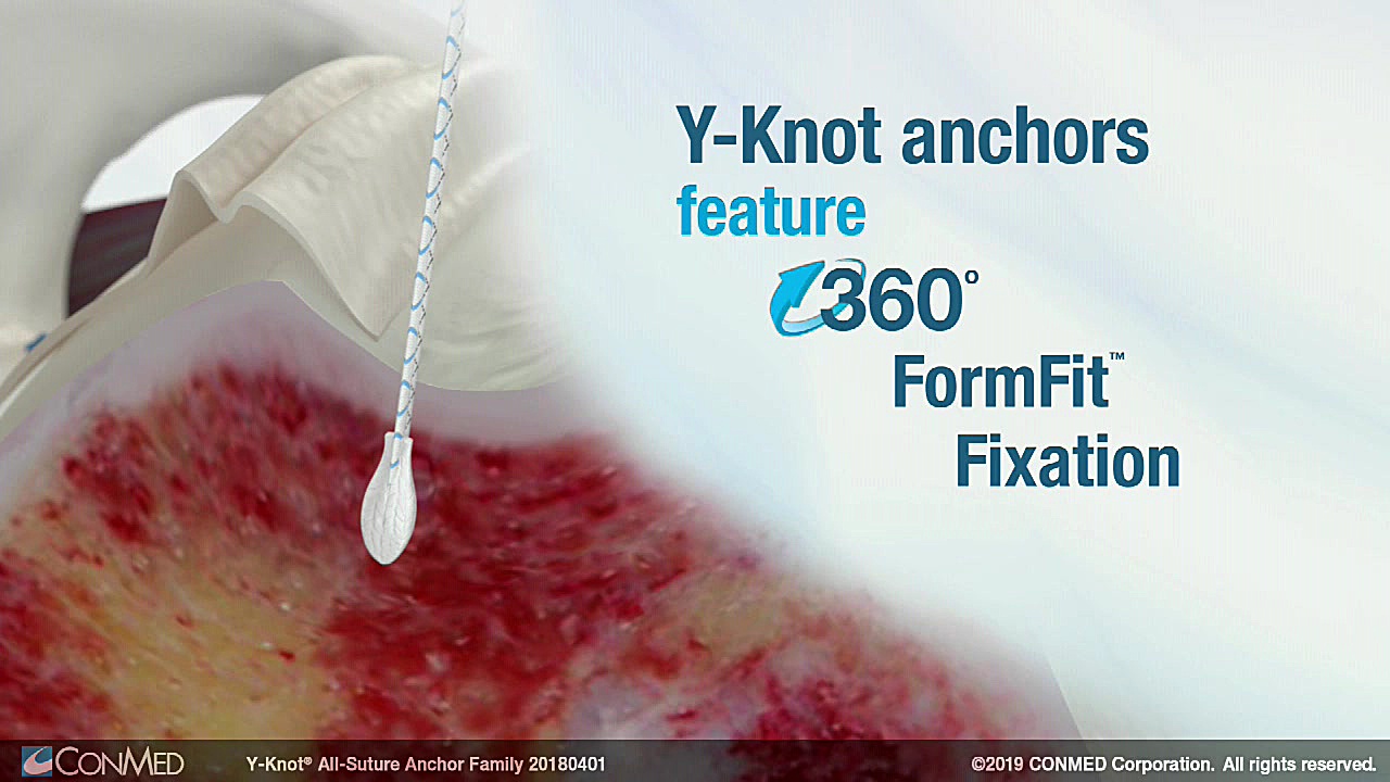 Y Knot&reg; All Suture Anchor...