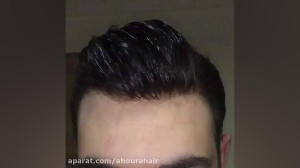 پروتز مو ترمیم مو