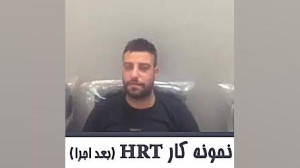 ترمیم مو پروتز مو