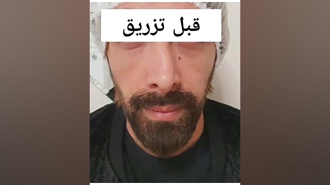 اصلاح فرم بینی با تزریق ژل