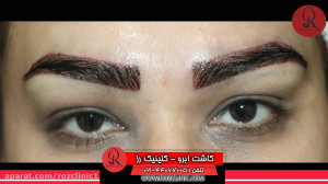 کاشت ابرو | فیلم کاشت ابرو | ک...