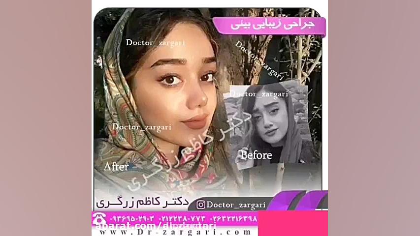 الو دکتر نمونه جراحی های بینی...