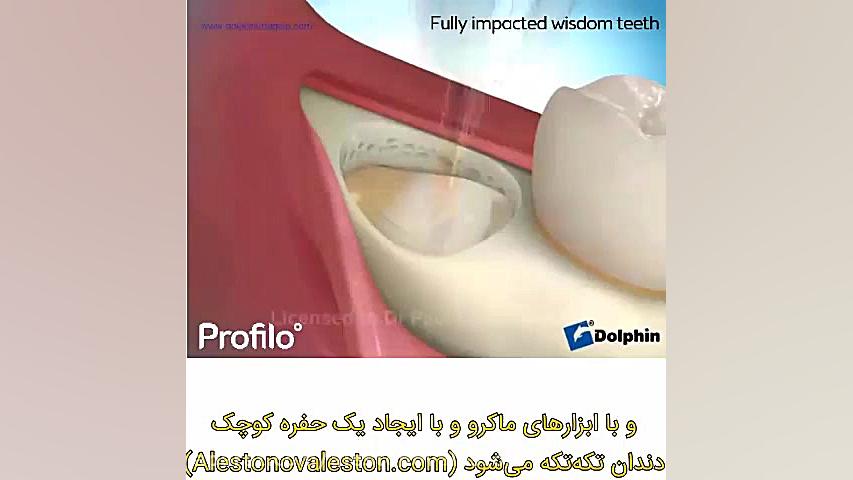 جراحی دندان عقل نهفته چیست؟