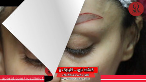 کاشت ابرو | فیلم کاشت ابرو | ک...