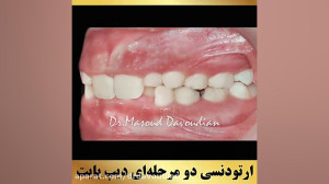 ارتودنسی دو مرحله ای دیپ بایت...