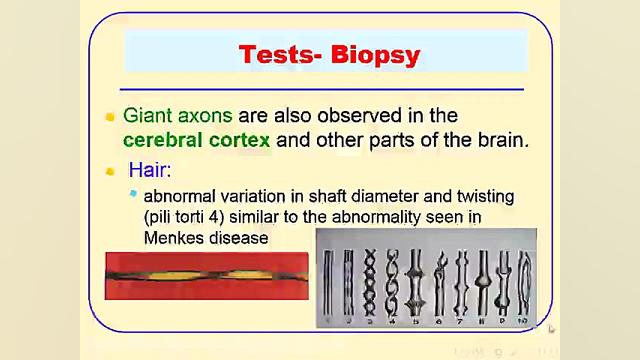 Giant Axonal Neuropathy