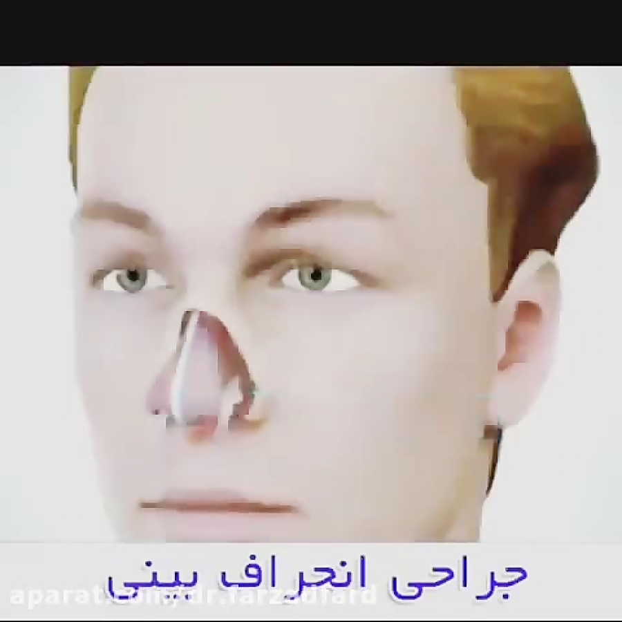 عملیه انحراف الانف