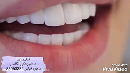 تفاوت لمینیت با ونیر کامپوزیت...